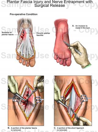 Steroid injection plantar fascia rupture